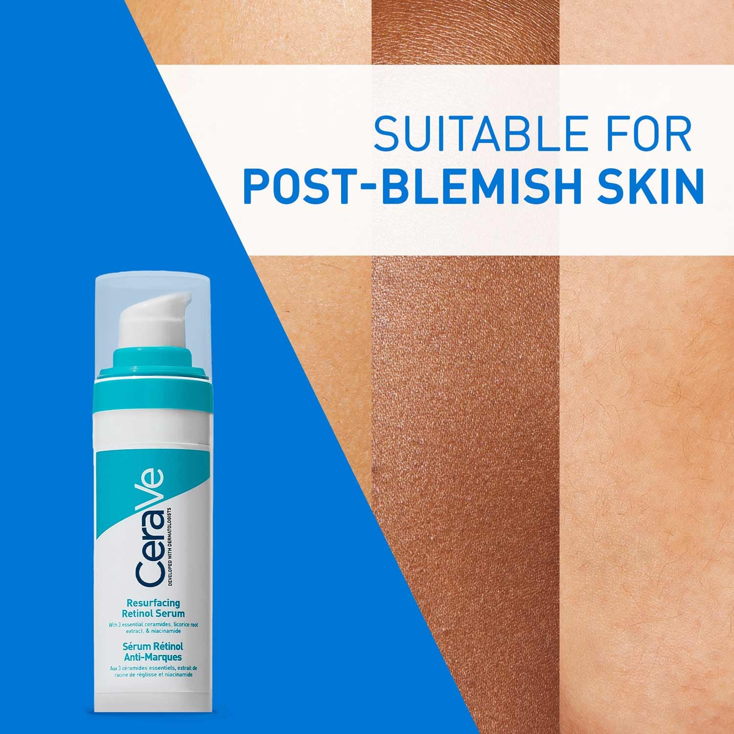 CeraVe Resurfacing Retinol Serum For Blemish-Prone Skin, Reduces Post Acne Marks & Pores, Formulated with Licorice Root Extract & Niacinamide, Non-Comedogenic, 30ml